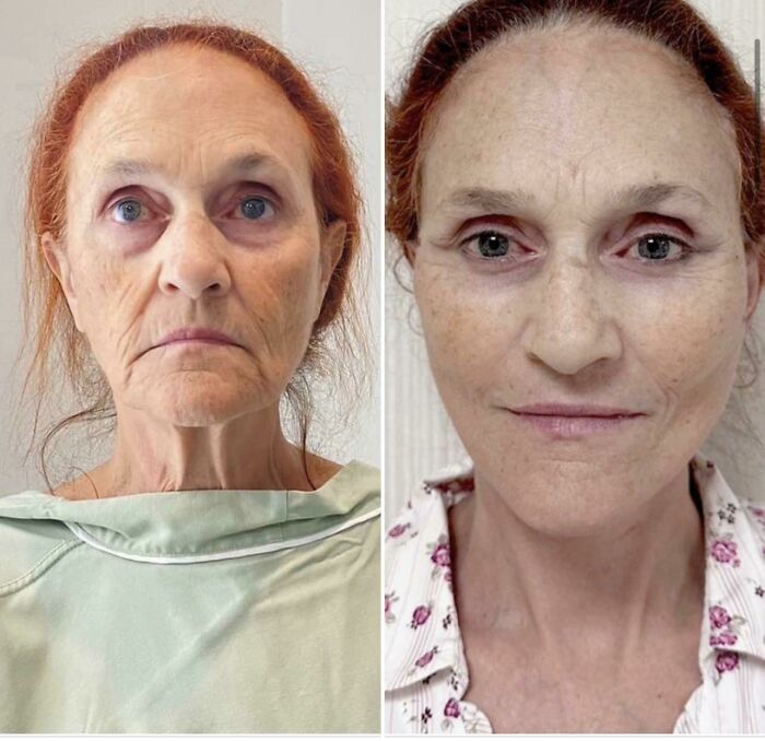 Mujer antes y después de cirugía plástica, mostrando resultados visibles y rejuvenecimiento facial.