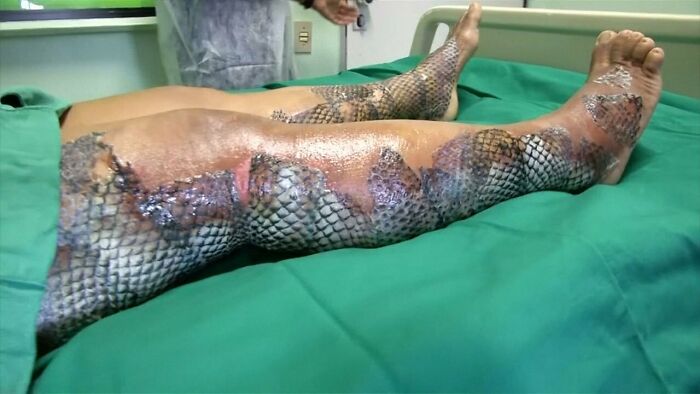 Pierna con quemaduras graves que muestran textura escamosa, una de las fotos médicas que demuestra que el cuerpo es aterrador.