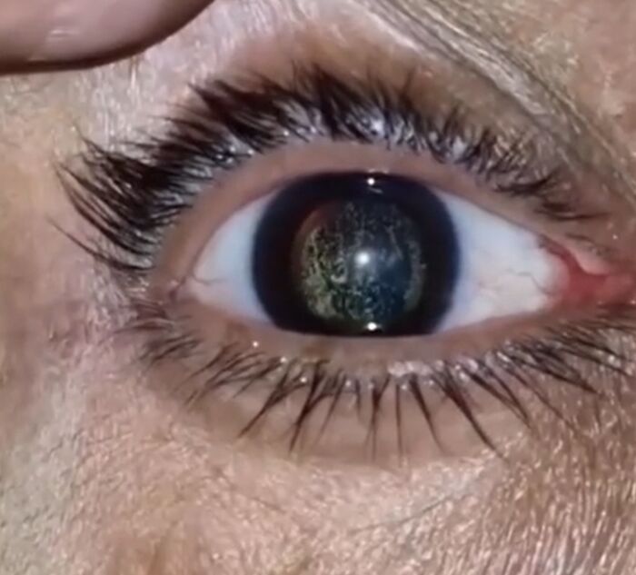 Ojo humano con reflejo inusual mostrando un detalle médico que evidencia cómo el cuerpo puede ser aterrador.
