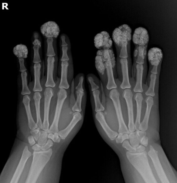 Radiografía de manos mostrando anomalías óseas con crecimiento anormal, ejemplo impactante de fotos médicas del cuerpo aterrador.