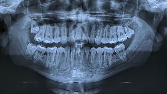 Radiografía médica mostrando mandíbula y dientes con detalles anatómicos, parte de fotos médicas del cuerpo aterrador.