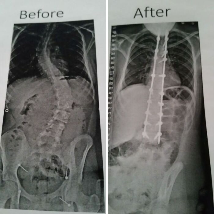Radiografías médicas que muestran corrección quirúrgica de la columna con implantes, ejemplificando fotos médicas aterradoras del cuerpo humano.