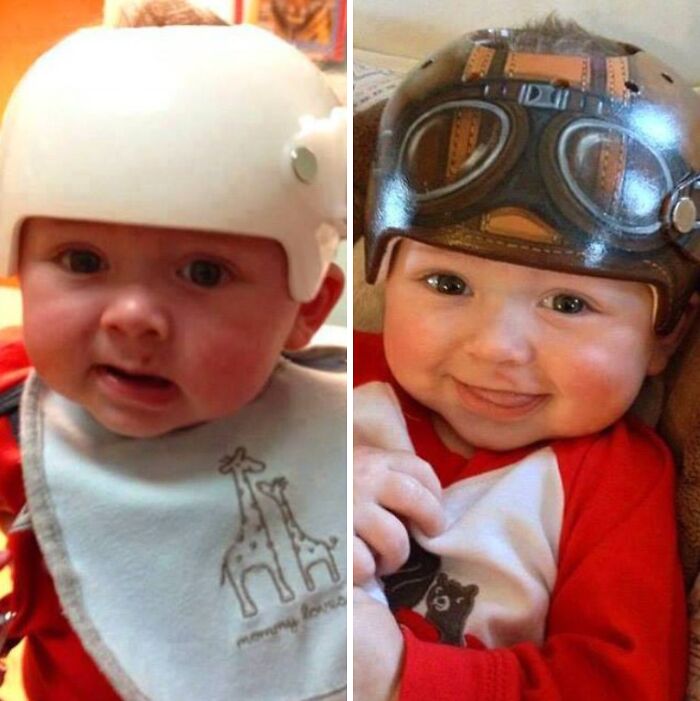 Bebé con casco médico ortopédico en distintas etapas, mostrando fotos médicas que demuestran que el cuerpo es a veces aterrador.