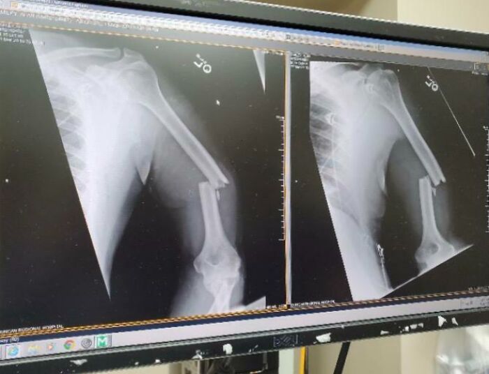 Radiografía médica que muestra una fractura ósea severa, ejemplificando lo aterrador que puede ser el cuerpo humano.