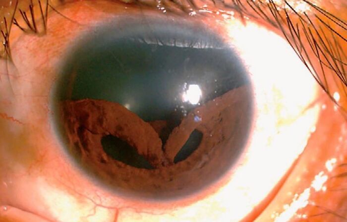 Primer plano de un ojo con una anomalía médica visible en la pupila, demostrando que el cuerpo puede ser aterrador.