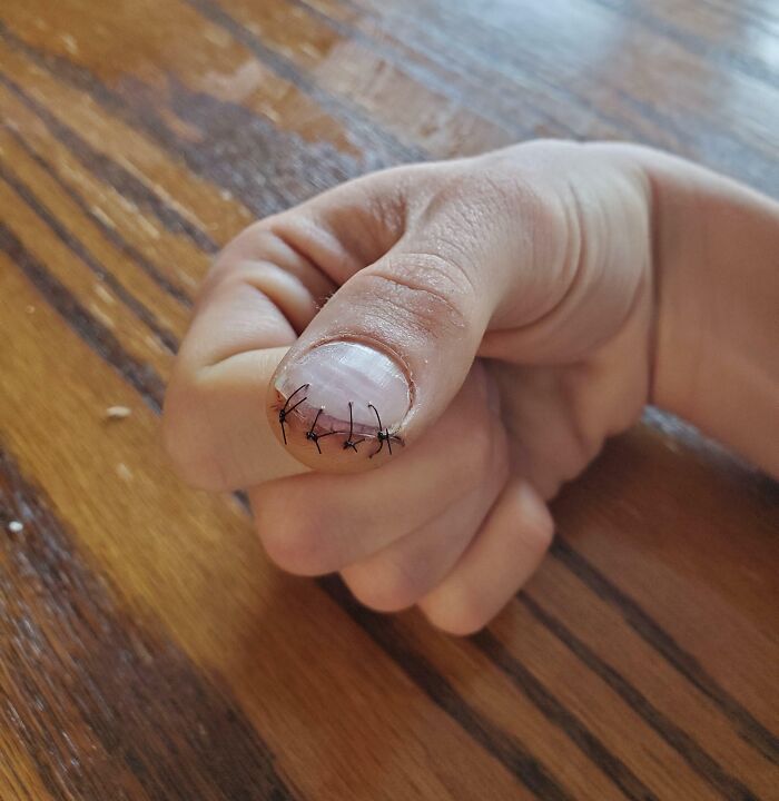 Mano con puntos de sutura en la uña, mostrando una imagen médica que destaca lo aterrador que puede ser el cuerpo humano.