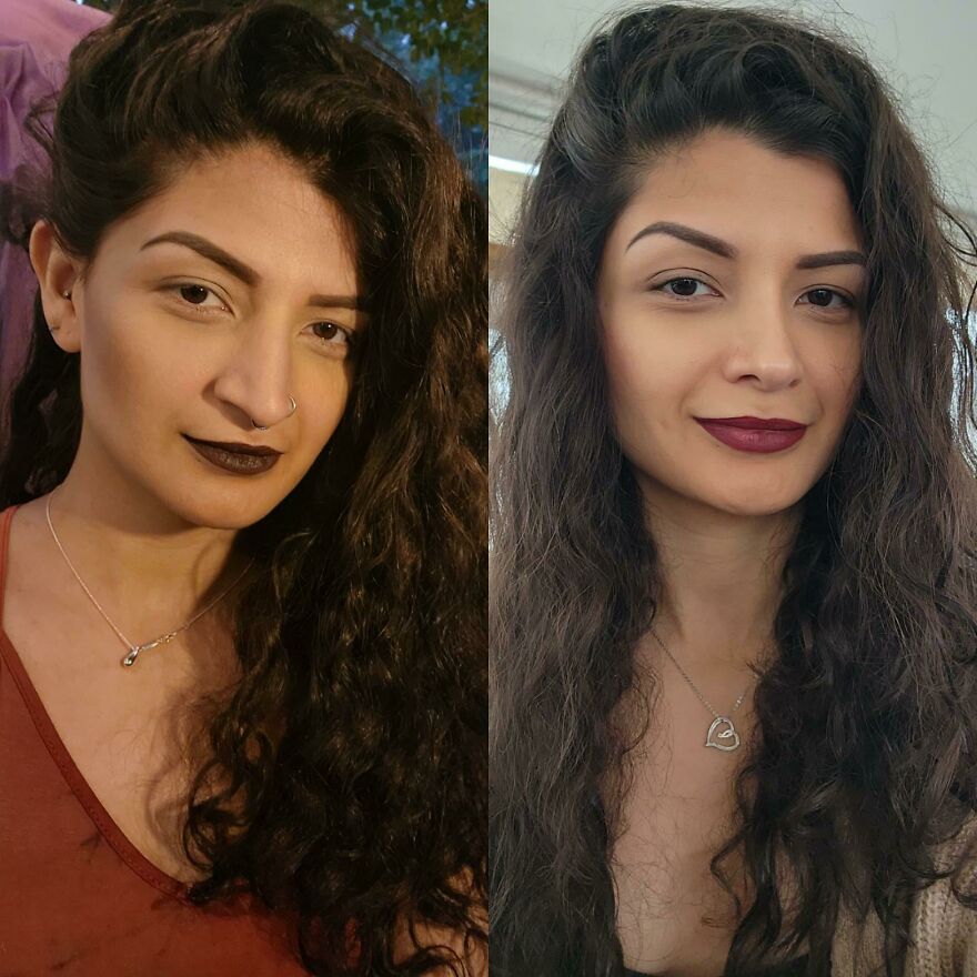 Comparación antes y después de rinoplastia primaria a los 9 meses, mostrando reducción de inflamación y resultado exitoso.