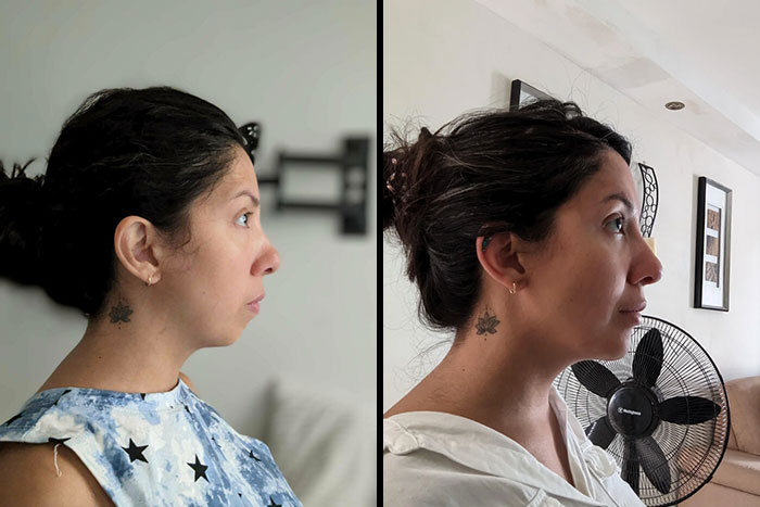 Mujer mostrando cambios visibles en su perfil facial tras cirugía plástica, ejemplo de personas irreconocibles.