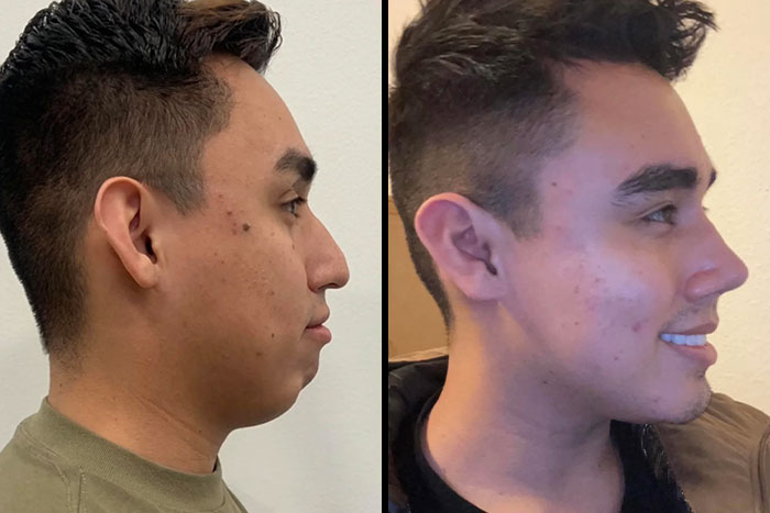 Perfil masculino antes y después de cirugía plástica mostrando cambio notable e irreconocible tras procedimiento estético.