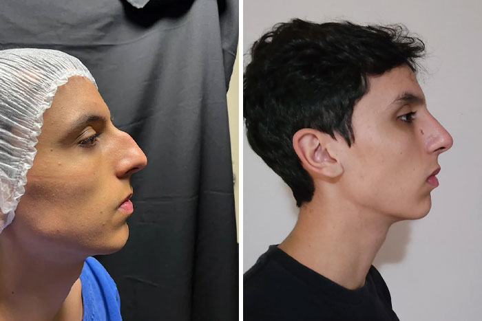 Antes y después de joven que se ve irreconocible tras su cirugía plástica, mostrando cambios en el perfil facial.