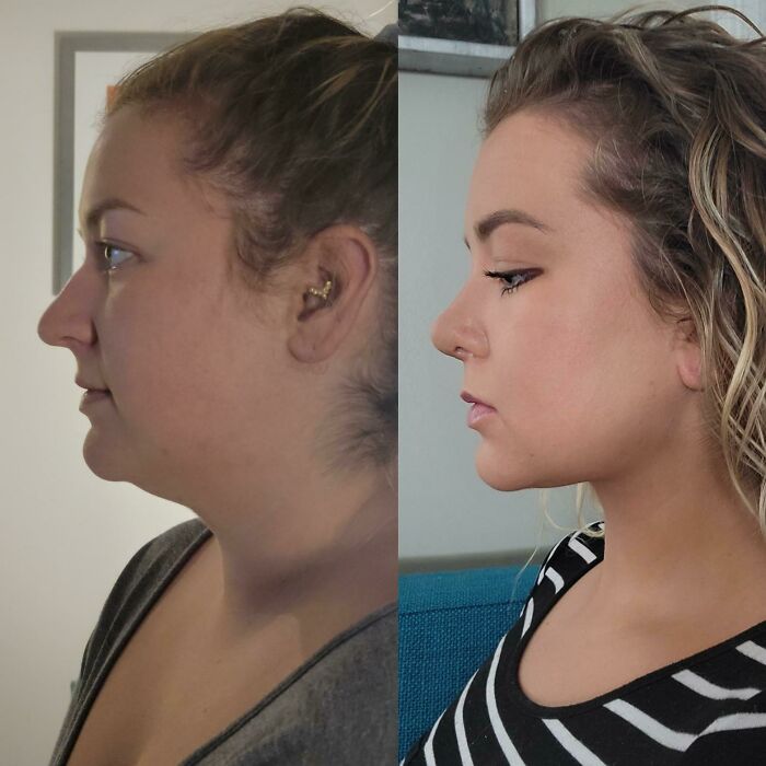 Mujer antes y después de cirugía plástica, mostrando cambios irreconocibles en su perfil y contorno facial.