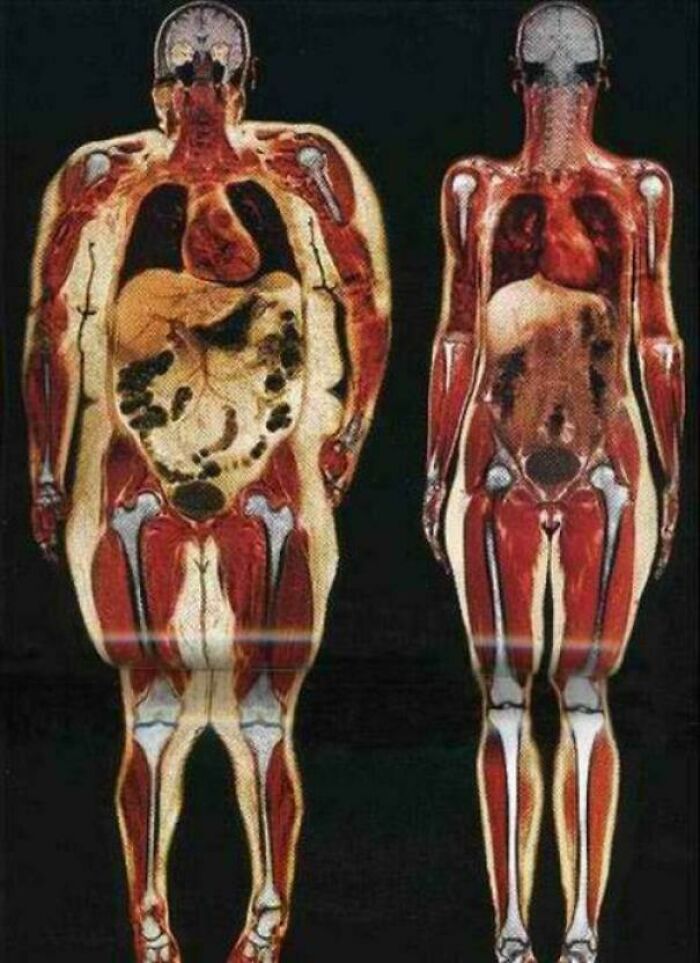 Imagen de escáner corporal que muestra diferencias internas entre dos cuerpos, una de las cosas interesantes que la gente encontró.