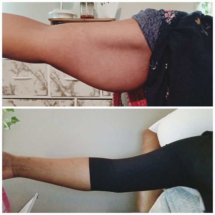 Antes y después del cambio en el brazo de una persona, mostrando resultados de cirugía plástica visibles y transformación notable.