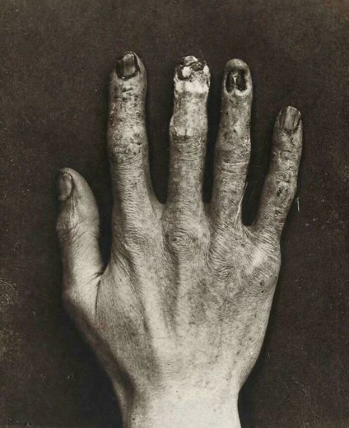 Mano afectada con daños visibles en las uñas y piel, imagen médica fascinante y perturbadora.