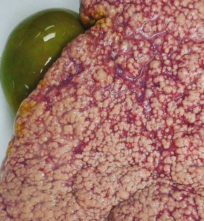 Textura pulmonar con afección visible y líquido verde en imagen impactante de fotos médicas fascinantes y perturbadoras.