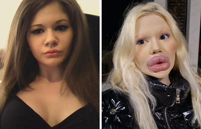 Comparación de mujer antes y después de cirugías plásticas extremas mostrando cambios físicos notorios y transformación facial.