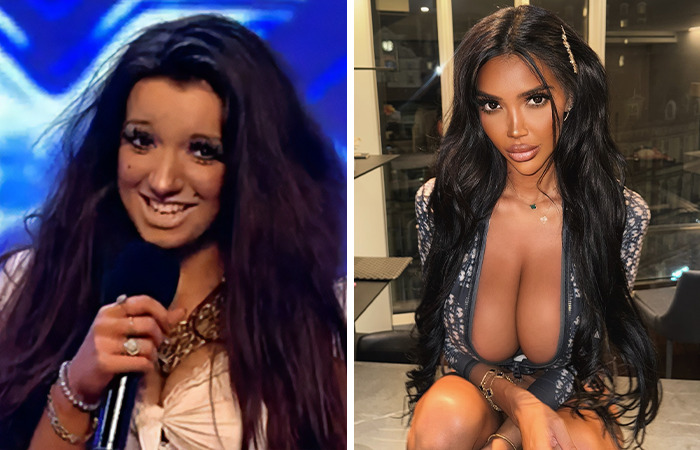 Antes y después de una mujer con cambios notorios por cirugías plásticas extremas y transformación radical.