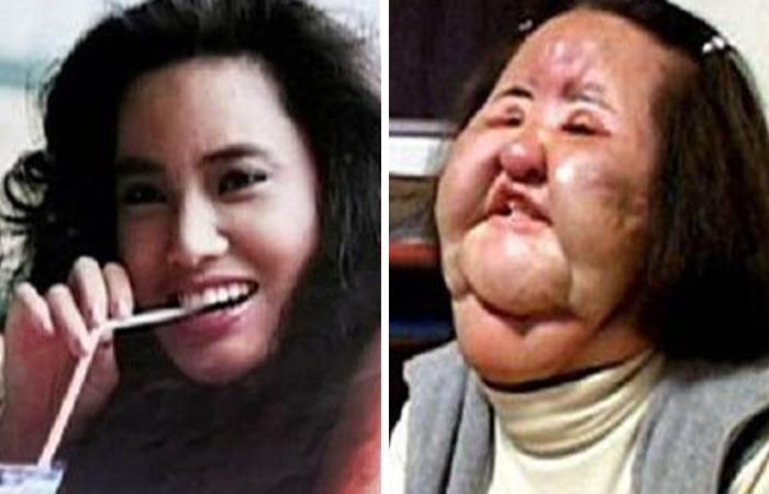 Comparativa de una mujer antes y después de cirugías plásticas extremas mostrando transformación impactante.