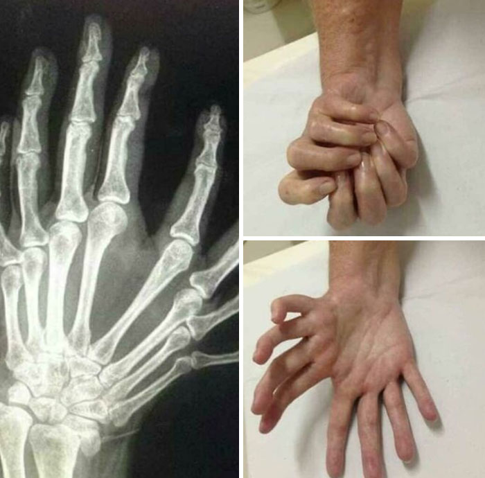 Radiografía y fotos médicas que muestran deformidades en las manos, evidenciando lo aterrador que puede ser el cuerpo humano.