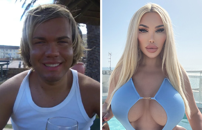 Hombre antes y después de cirugías plásticas extremas mostrando transformación común impactante y cambios faciales y corporales.