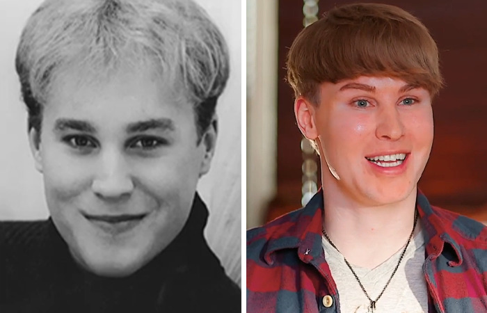 Hombre joven antes y después de cirugías plásticas extremas mostrando un cambio notable en su apariencia facial.