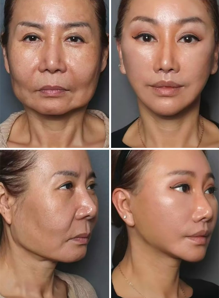 Mujer mostrando resultados positivos de cirugía plástica en rostro, antes y después con piel más lisa y rejuvenecida.