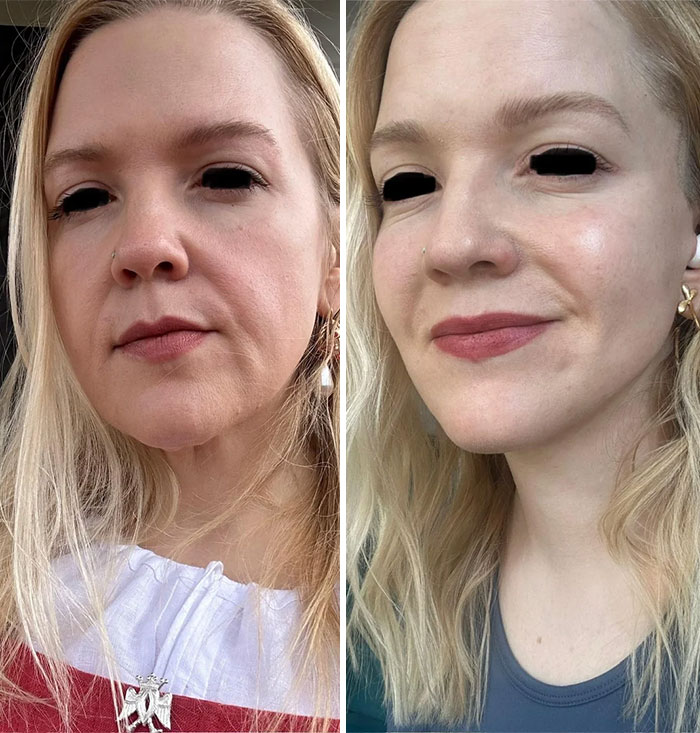 Mujer rubia mostrando comparación antes y después de cirugía plástica con resultados visibles y confianza renovada.