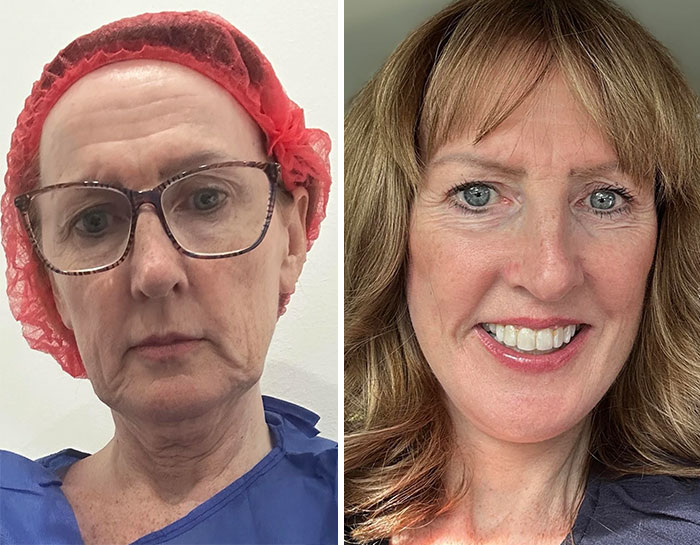 Mujer antes y después de cirugía plástica mostrando resultados naturales y expresando satisfacción con su cambio estético.
