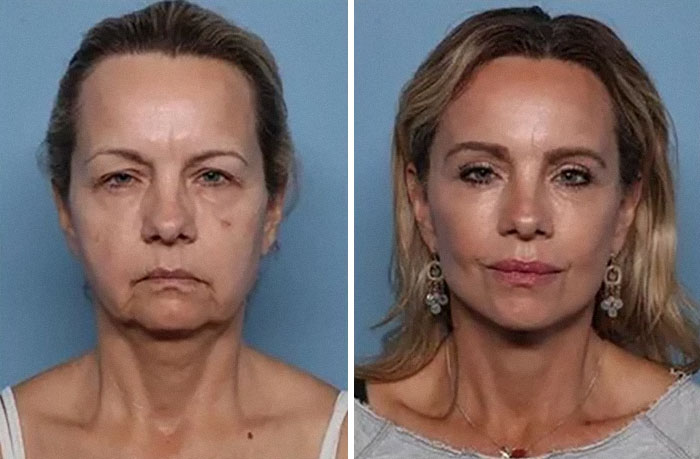 Antes y después de una mujer que no se arrepiente de su cirugía plástica, mostrando resultados visibles y rejuvenecidos.