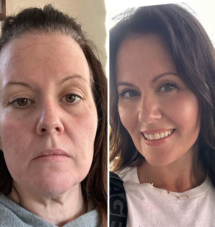 Antes y después de cirugía plástica en mujer, mostrando resultados satisfactorios y sin arrepentimiento visible.