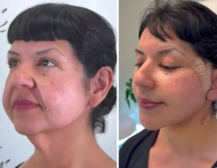 Mujer mostrando resultados de cirugía plástica facial, antes y después, demostrando satisfacción con el procedimiento.