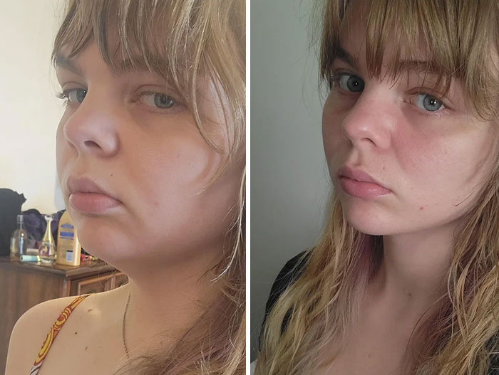 Mujer joven antes y después de cirugía plástica mostrando resultados naturales y sin arrepentimientos.