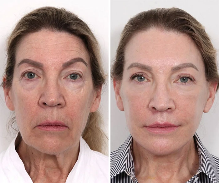 Mujer antes y después de cirugía plástica mostrando resultados visibles y naturales sin arrepentimientos tras el procedimiento.