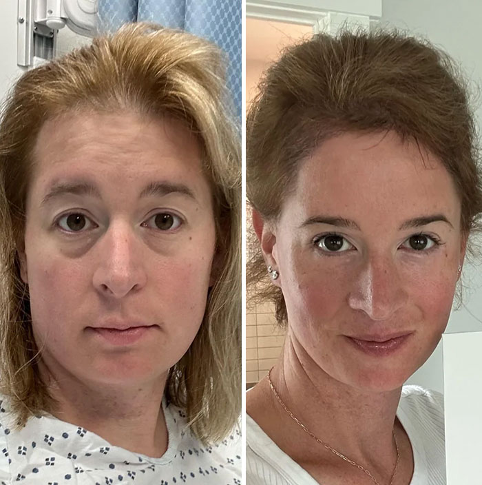 Mujer mostrando cambio visible en rostro antes y después de cirugía plástica, ejemplo de personas que no se arrepienten.