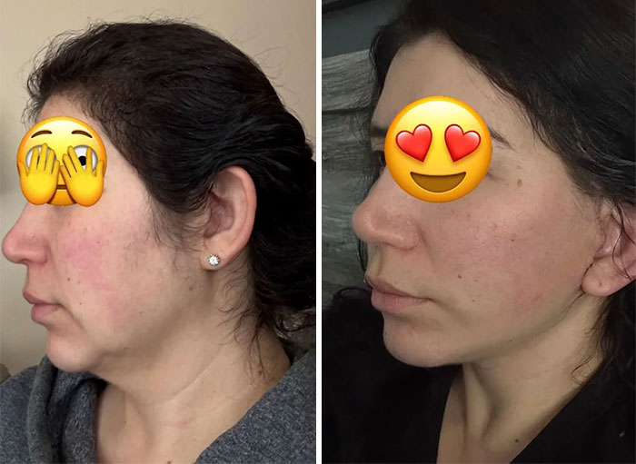 Mujer mostrando resultado positivo en cirugía plástica, cambio visible en el rostro y perfil tras el procedimiento.