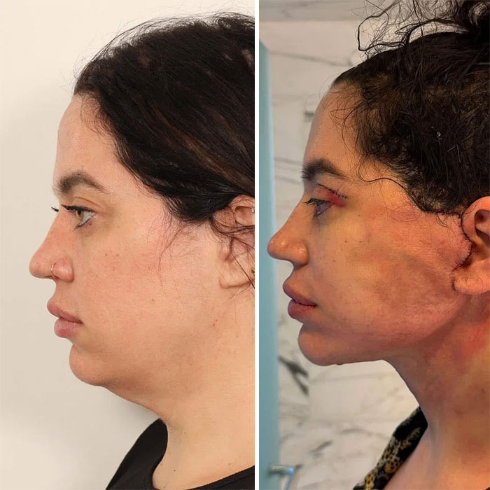 Antes y después de cirugía plástica mostrando cambios en el rostro de una mujer que no se arrepiente de su decisión.