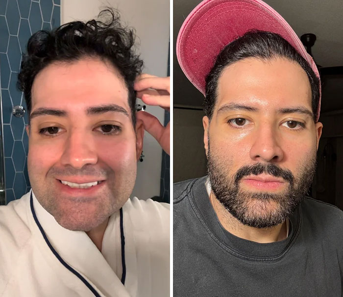 Hombre antes y después de cirugía plástica, mostrando cambios positivos y confianza en su nuevo aspecto facial.