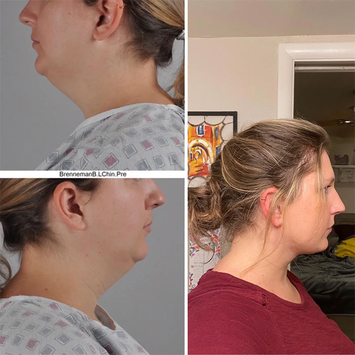 Antes y después de una mujer que muestra resultados visibles de cirugía plástica en el área del mentón y cuello.