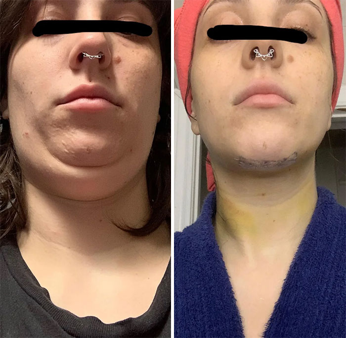 Antes y después de cirugía plástica facial en paciente que no se arrepiente en absoluto de su procedimiento estético.
