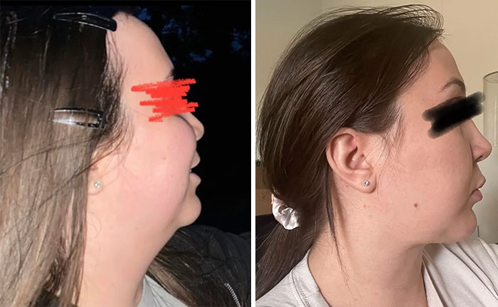 Mujer antes y después de cirugía plástica, mostrando resultados visibles y satisfacción con procedimiento estético facial.