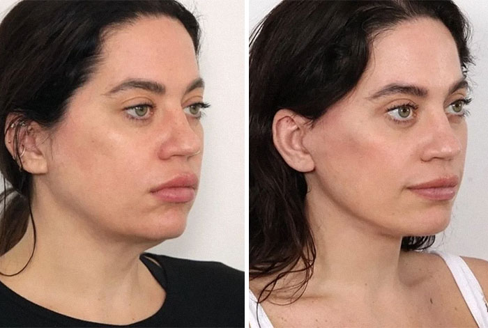 Mujer mostrando resultados visibles de cirugía plástica en rostro, antes y después, sin arrepentimiento.