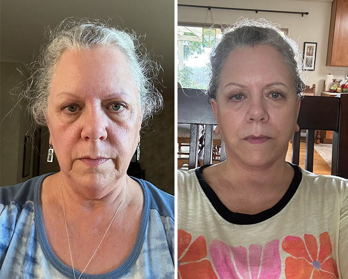 Mujer antes y después de cirugía plástica mostrando resultados visibles y naturales sin arrepentimiento ni signos de edad.
