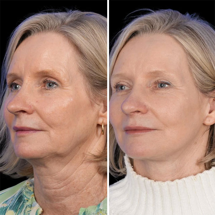 Mujer mayor mostrando antes y después de cirugía plástica en el rostro, con piel más lisa y rejuvenecida.