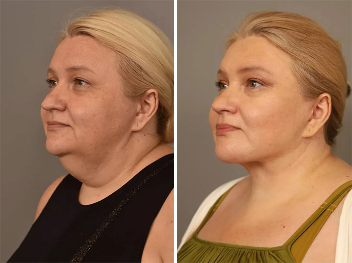 Mujer antes y después de cirugía plástica, mostrando resultados claros y naturales en su rostro y cuello.