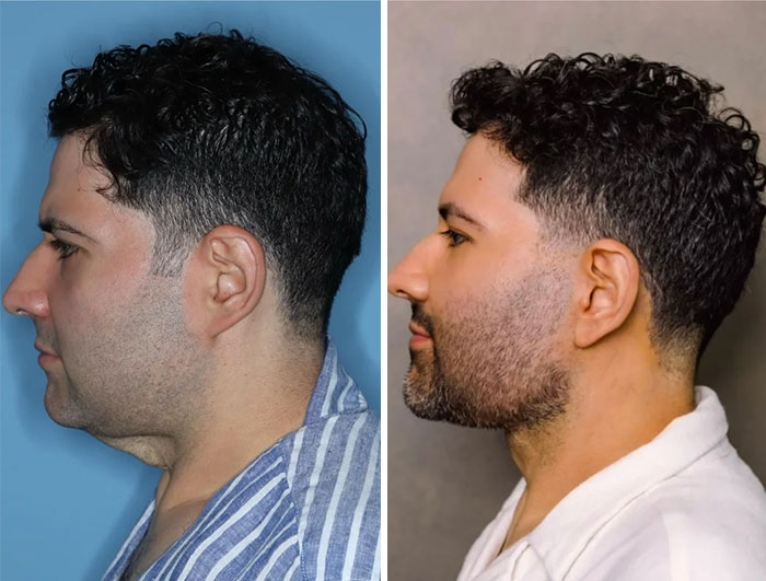 Hombre antes y después de cirugía plástica con cambio visible en perfil y contorno facial mejora su apariencia.