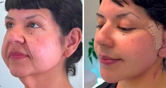 27 Personas que no se arrepienten en absoluto de su cirugía plástica