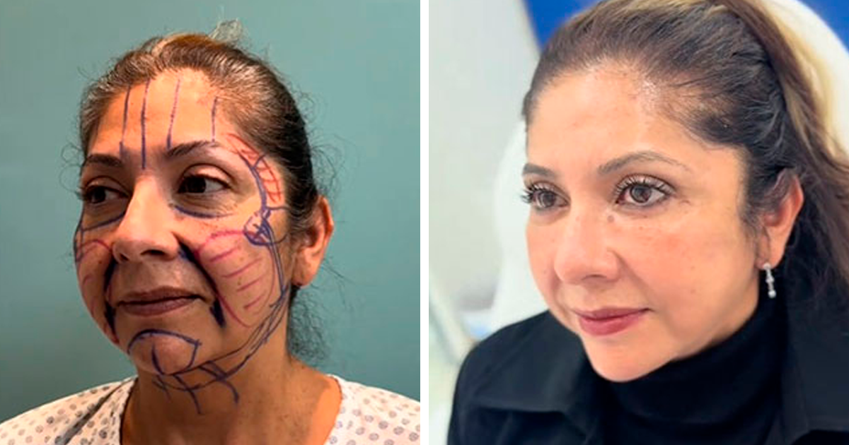 Mujer antes y despuu00e9s de cirugu00eda plu00e1stica facial con marcas de planificaciu00f3n quiru00fargica en rostro y resultado final visible.