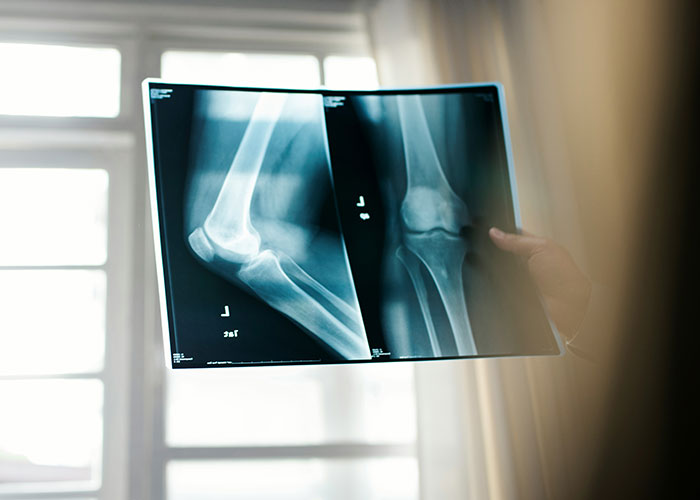 Radiografía de codo analizada por médico mostrando caso médico donde paciente debió acudir mucho antes al especialista.
