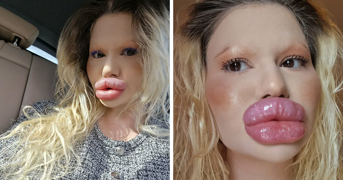 Mujer con los labios mu00e1s grandes del mundo mostrando su rostro tras gastar 26000 du00f3lares en cirugu00edas extremas.