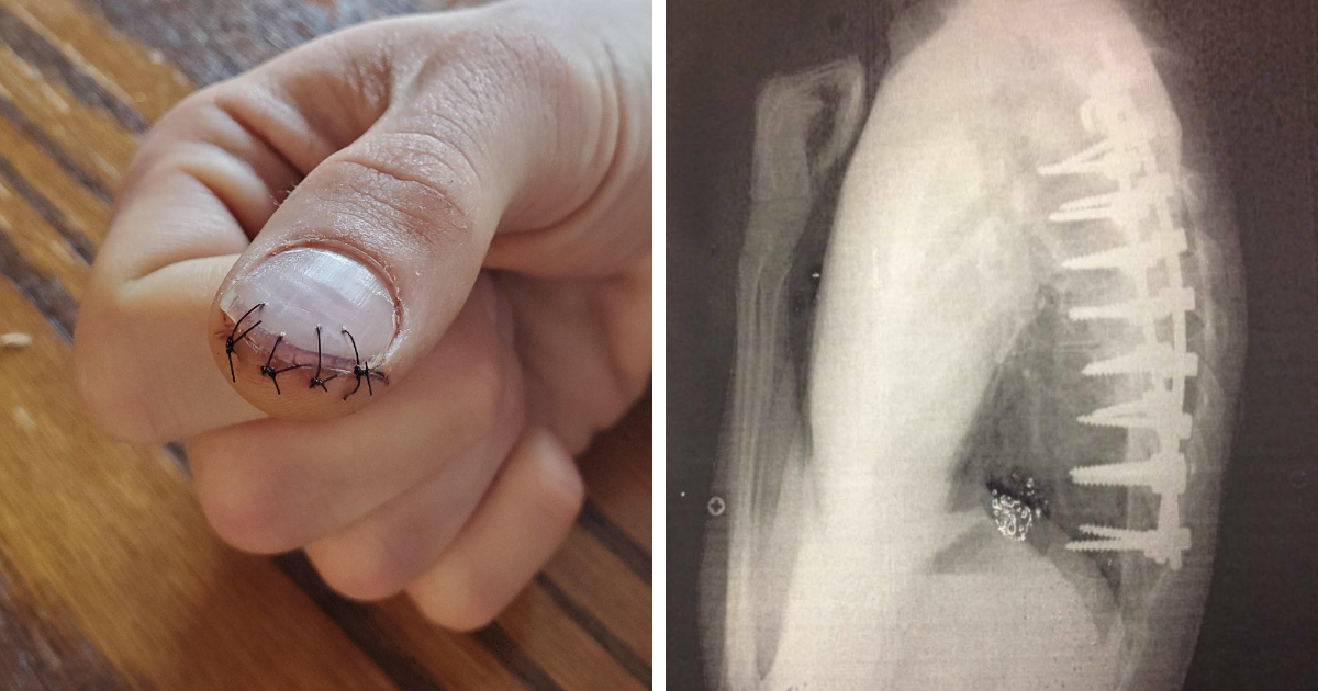 Imagen mu00e9dica que muestra un pulgar con puntos de sutura y una radiografu00eda con tornillos metu00e1licos en la columna.